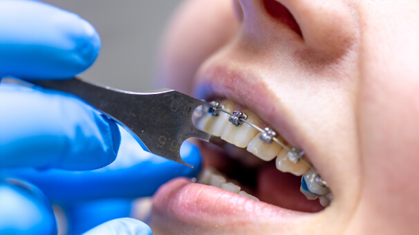 Braces and Clear Aligners