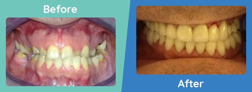 burbank-family-dental-before-after-full-mouth-reconstruction