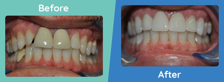 burbank-family-dental-before-after-porcelain-crowns-and-veneers