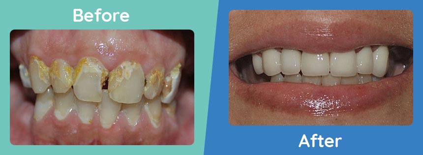 burbank-family-dental-before-after-Porcelain Crowns