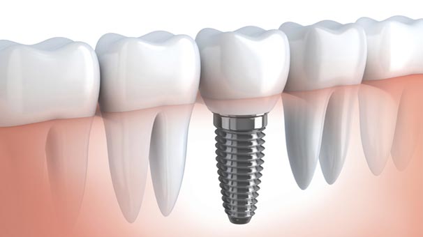 burbank family dental services Implant Dentistry