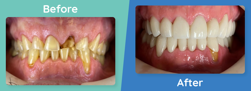 full-mouth-reconstruction-before-after-2